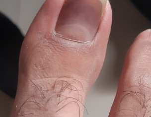 Toe Nail Issue