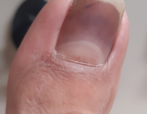 Toe Nail Issue