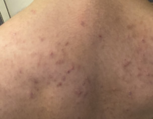 Pimples On Back