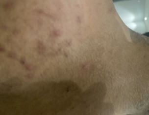 Pimples On Back