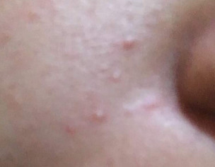 Face Acne Problem