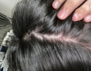 Scalp Pimples
