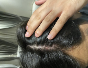 Scalp Pimples