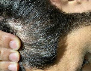 Scalp Pimples