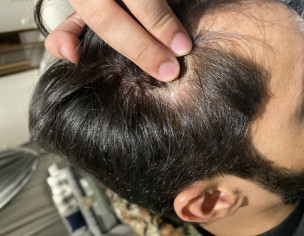 Scalp Pimples