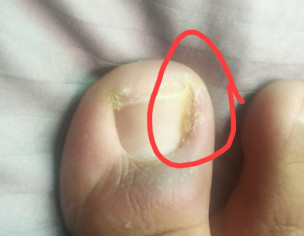 Mild Infection