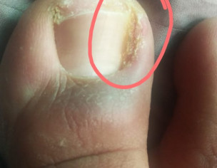 Mild Infection