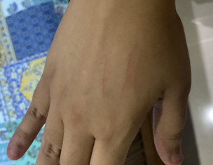 Cuts On Skin