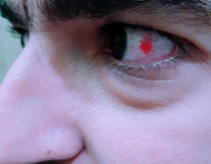 Eye Infection
