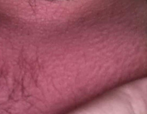 Eczema Itching