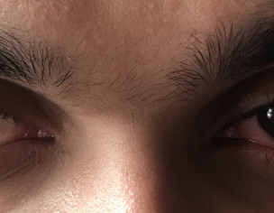 Eye Redness