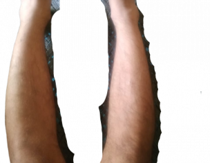 Bow Leg Problem