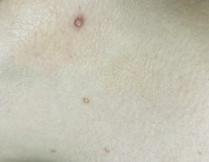 Bumps Around Neck