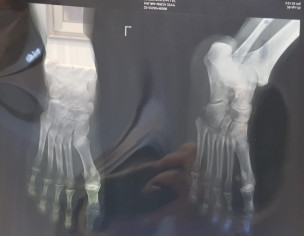 Ankle Sprain