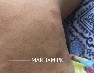 Ulticaria (Hives)