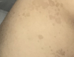 Patch On The Back