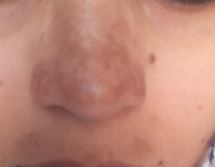 Pigmentation 