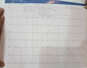 Need Opinion Regarding ECG