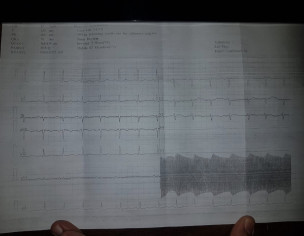 ECG Related 
