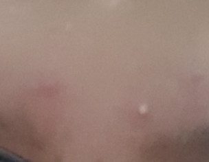 Pimple Problem 