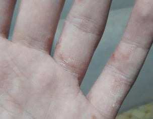 Acne On Hands 