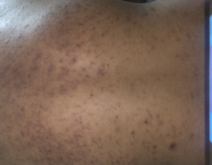 Acne At Back (kamar)