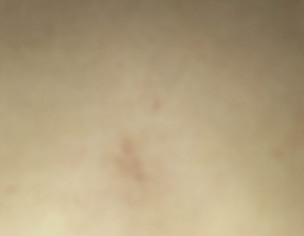 Allergic Problem