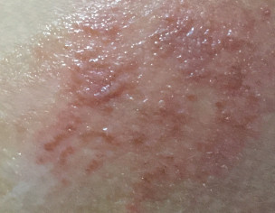 Pain And Itching