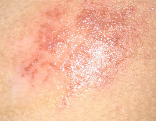 Pain And Itching