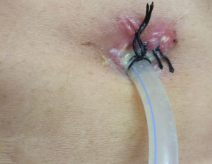 Gastrostomy
