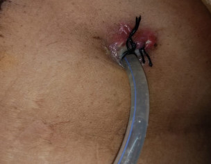 Gastrostomy