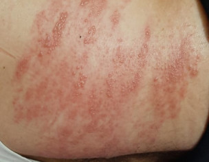 Skin Allergy 