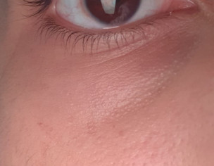 Red Eye Lining 