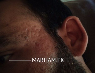 Skin Problem