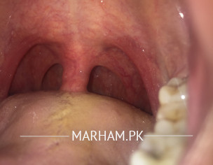 Throat Problem