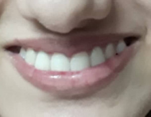 Smile Problem