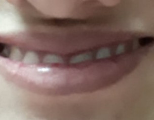 Smile Problem