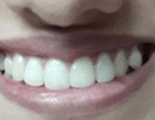 Smile Problem