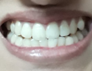 Smile Problem