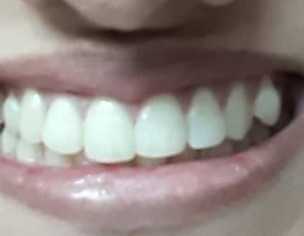 Smile Problem