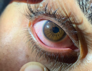 Eye Trauma