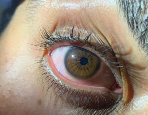 Eye Trauma