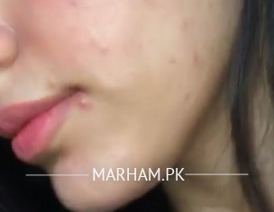 Recurring Acne