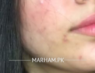 Recurring Acne