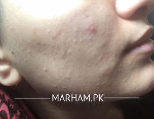 Recurring Acne