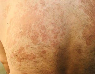 Skin Problem 