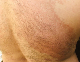 Skin Problem 