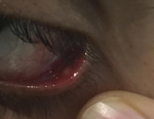 Eye Swelling 
