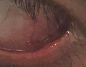 Eye Swelling 