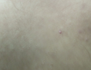 Skin Problem